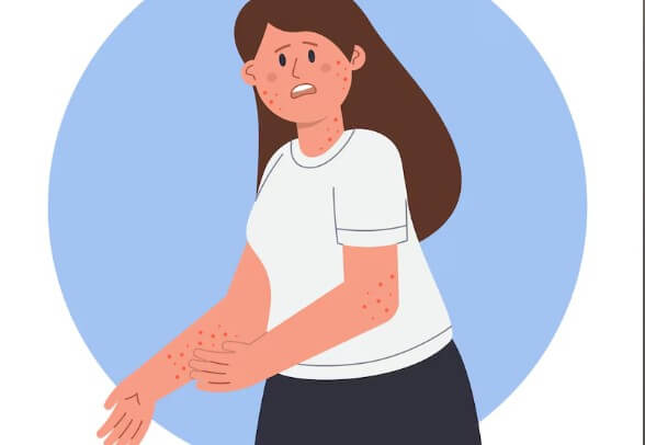 땀띠-자연-치유-치료-법-5