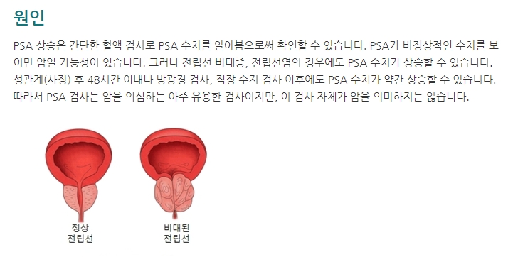 PSA 검사 방법 및 주의사항