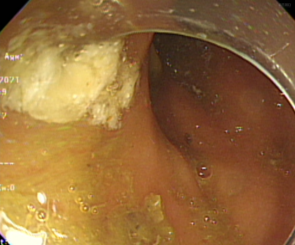 대장내시경 전 음식주의사항