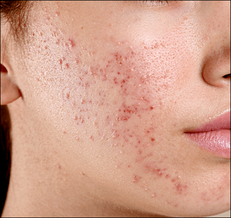 에스로반 연고 효능 가격 부작용