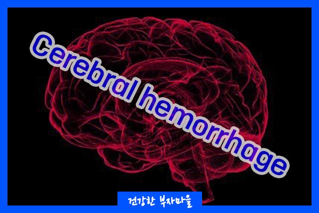 뇌출혈 후유증