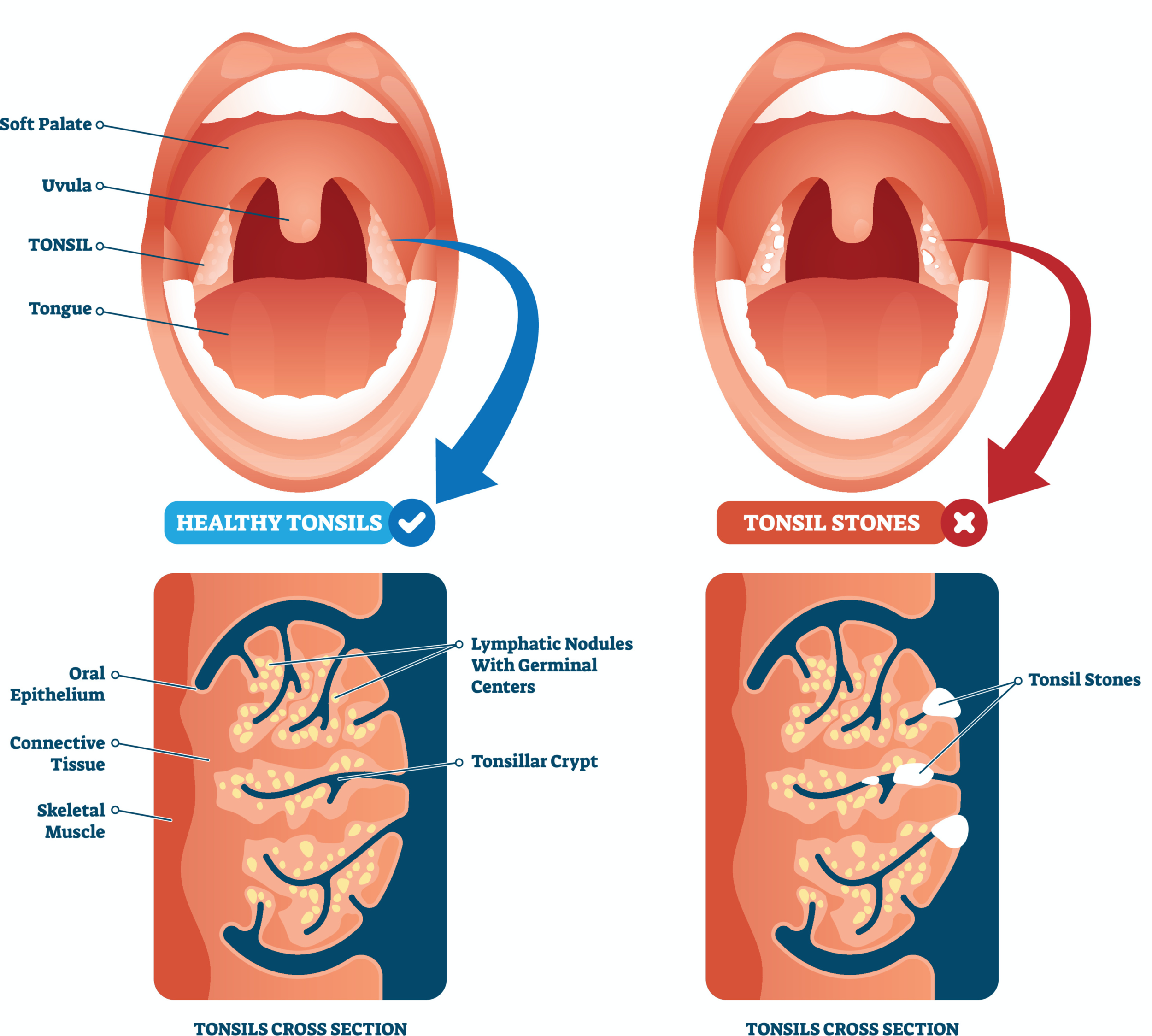 편도결석 발생 원리 설명 도식
