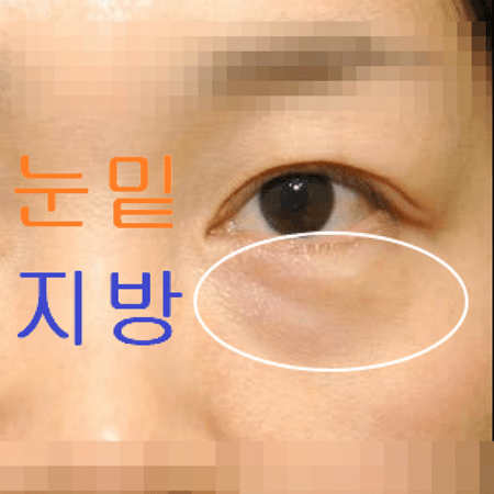 눈 밑에 지방이 쌓여 붓기가 나타나는 여성