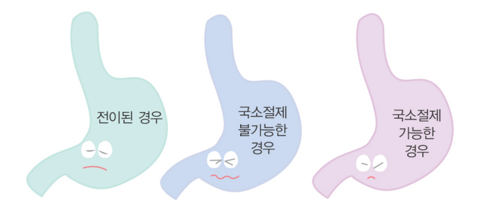 기스트(GIST&amp;#44; 위장관 기질 종양) 정의3