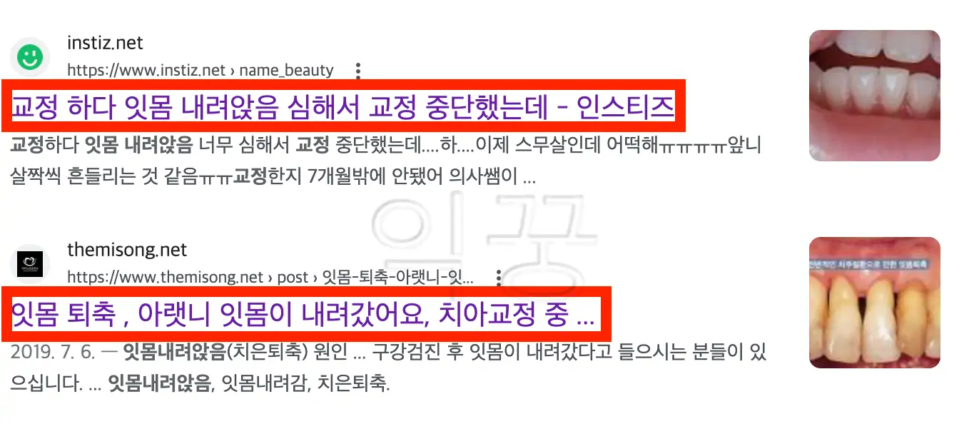 교정치료 중 잇몸 내려앉음 증상 나타났다는 게시물 사진