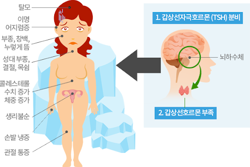 갑상선