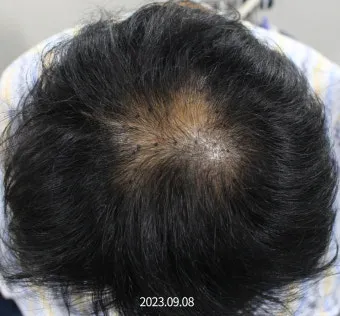 정수리가 아픈 이유와 완화하는 방법_19