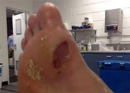 화상 물집 치료방법