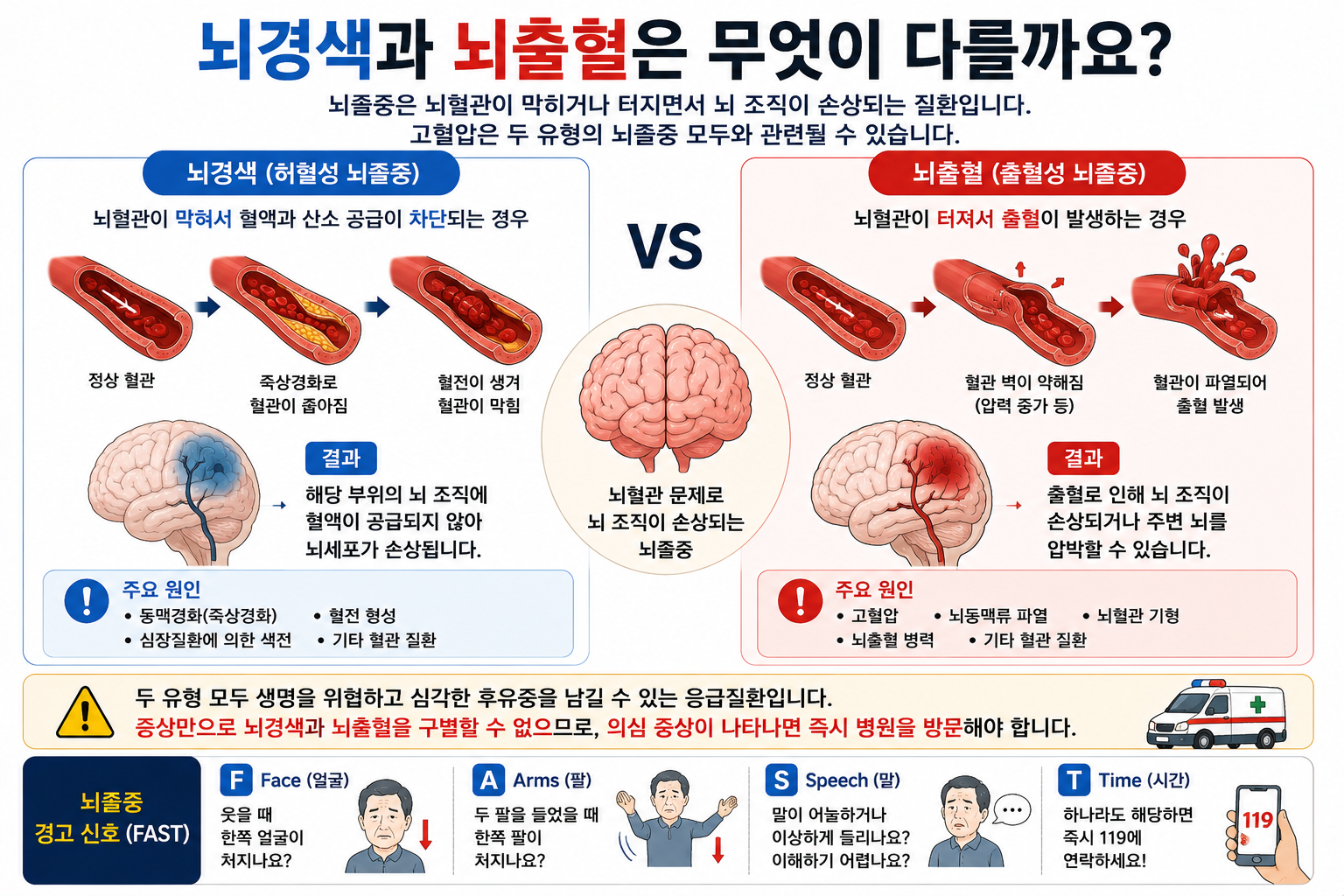 뇌경색·뇌출혈의 차이와 얼굴·팔·말 변화 시 119 행동