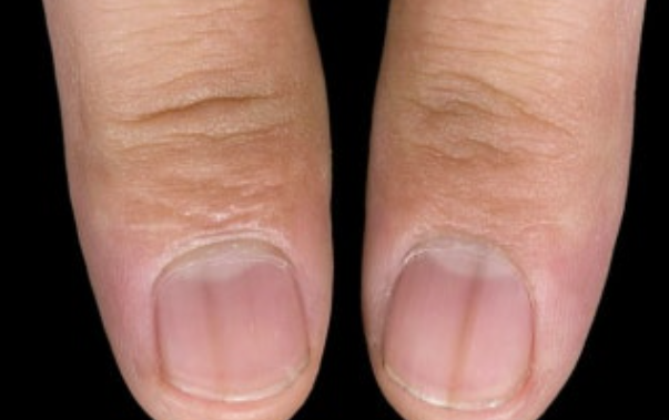 손톱 세로줄 관련된 사진3