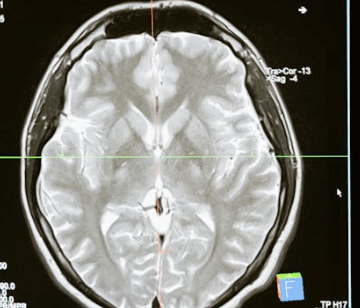 도파민 중독 증상, 병, 디톡스