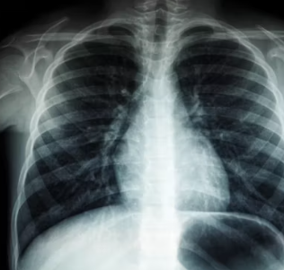 천식 증상 그대로 두면 위험하다 원인 예방법