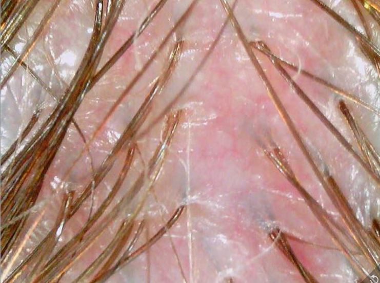 A revitalized and purified scalp environment after our targeted head spa therapy. The noticeably clear&amp;#44; pale scalp color indicates effectively relieved tension and restored blood circulation. The surface is flawlessly clean with zero build-up&amp;#44; and the cold plasma booster has locked in soothing moisture for a relaxed&amp;#44; healthy texture.