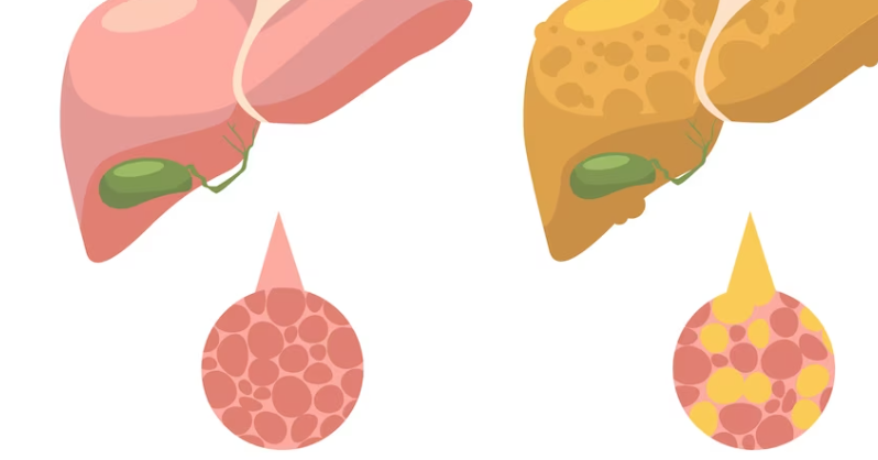 담도 폐색을 치료하는 방법 스텐트링