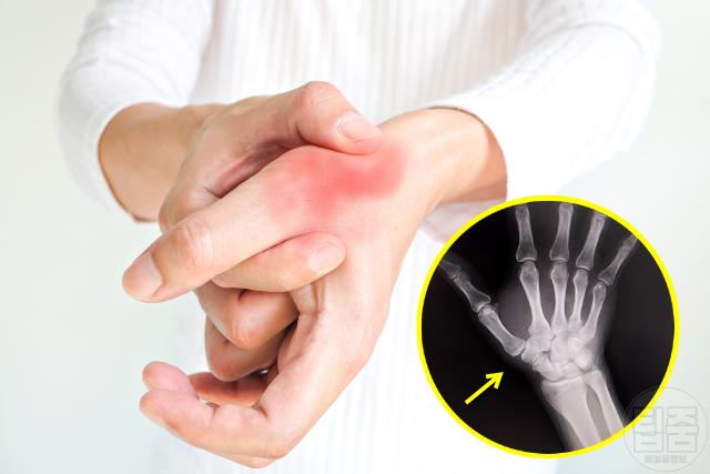 엄지손가락 관절 욱신 통증 자가진단