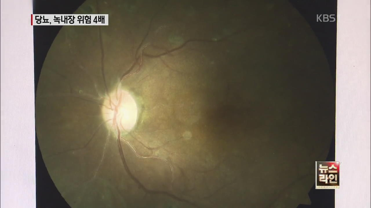당뇨환자라면 녹내장 걸릴 확률도 높나요?