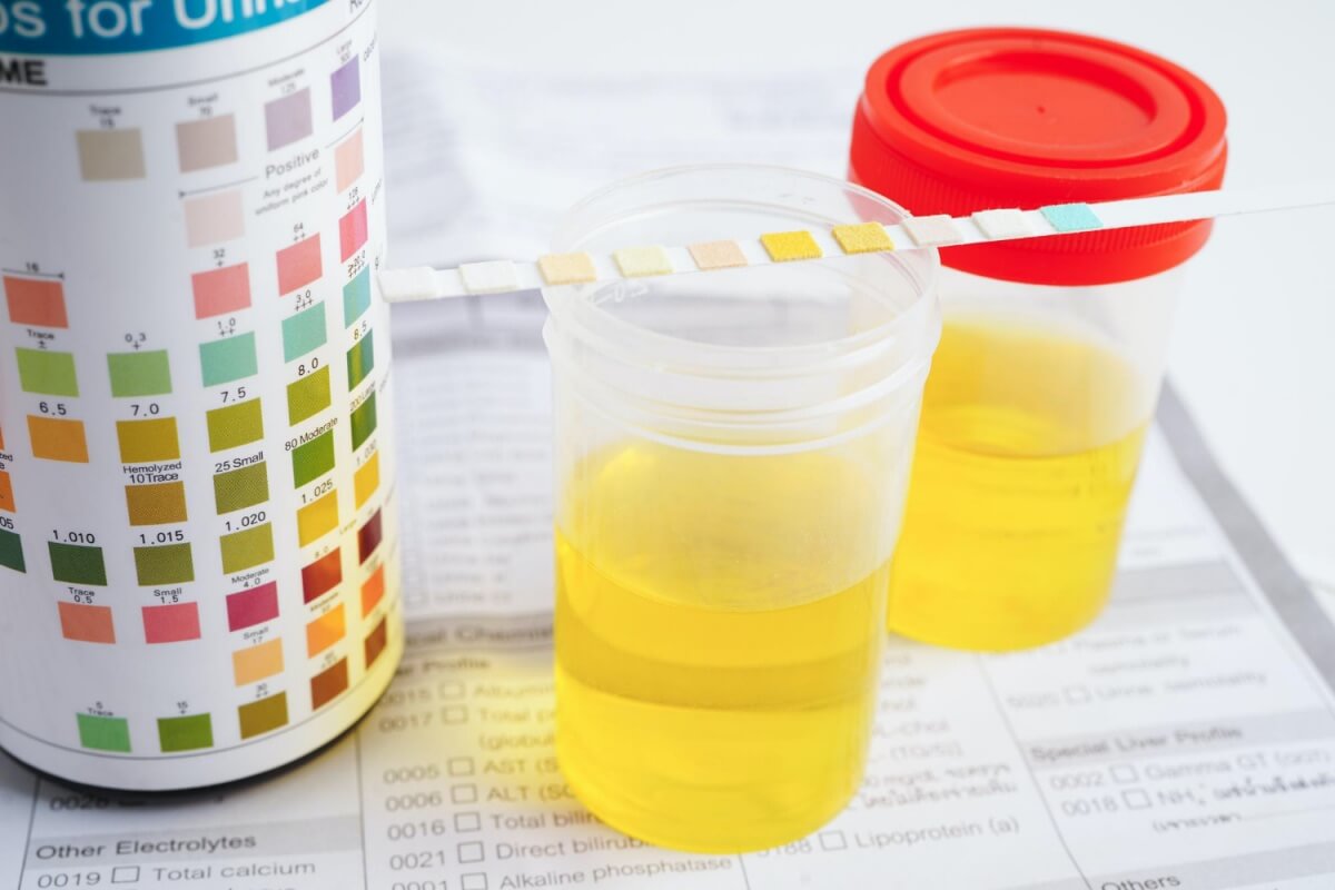 소변검사를-통해-찾을수있는-요잠혈