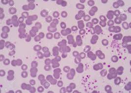 혈소판 수치 올리는 방법