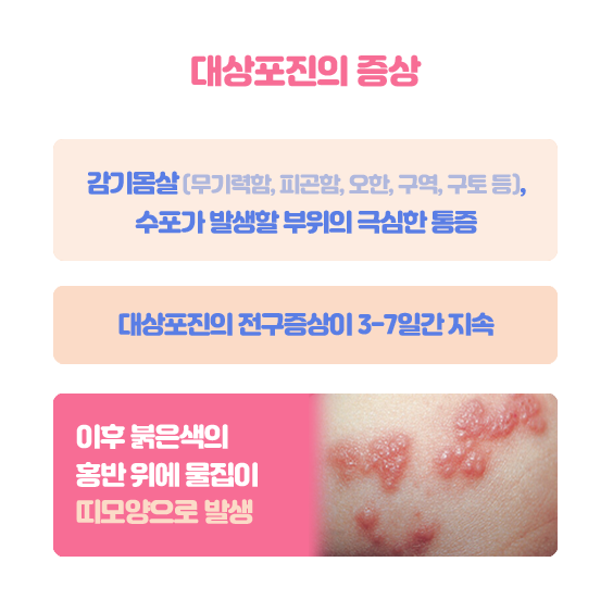 대상포진 증상