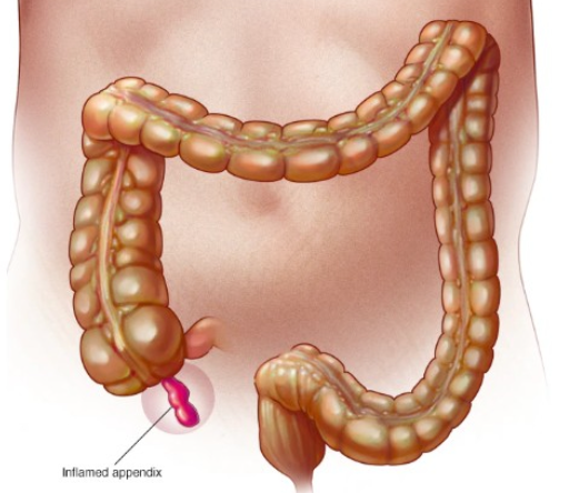 충수염의 치료법