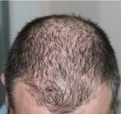 미녹시딜 부작용