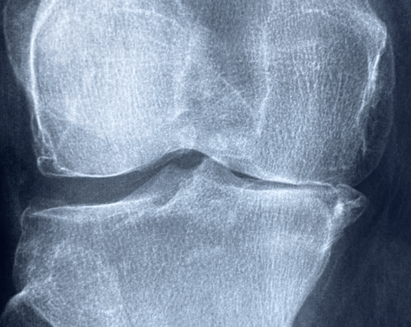 퇴행성관절염 원인 증상 치료방법