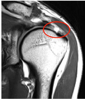 회전 근개 파열