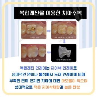 인레이 온레이의 차이와 치료 방법_21