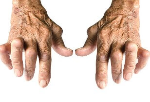 손가락 관절염