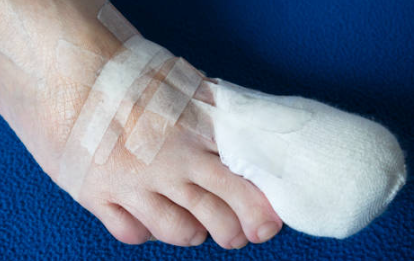 내성발톱 자가치료 교정기 내성발톱 수술 테이프 제품 추천