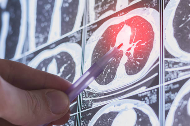 폐암 4기 진단받았다면? 생존율과 최신 치료법 총정리