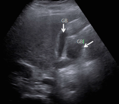 담낭의 정상변이 (normla variation)