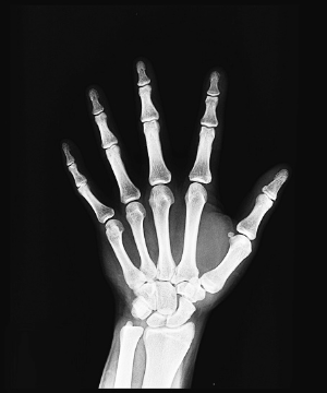 류머티스관절염-이미지