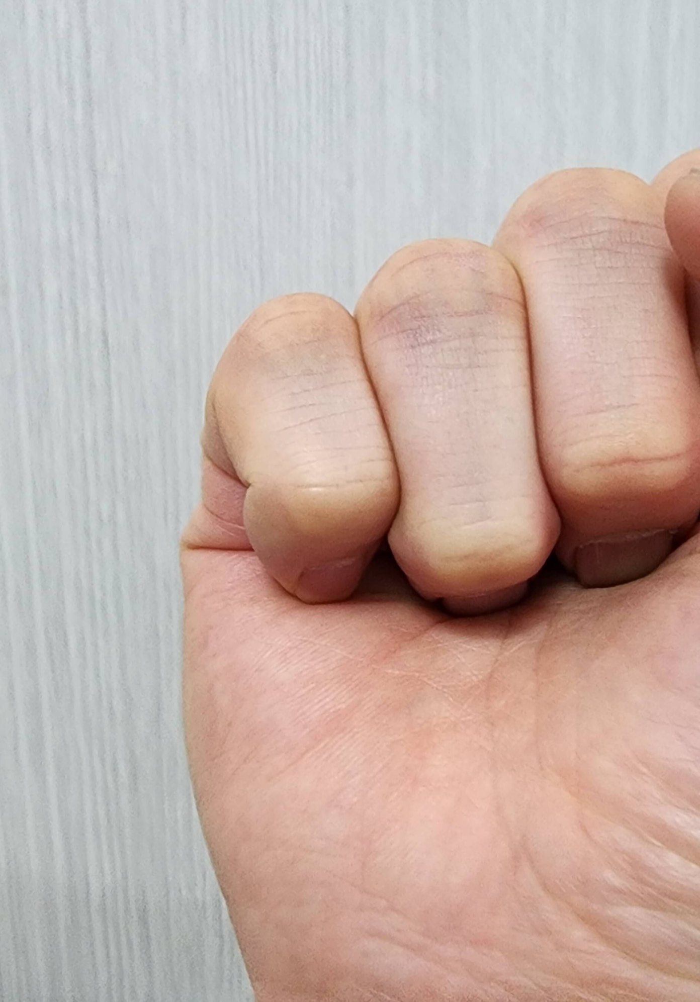 손가락이정상으로돌아온사진