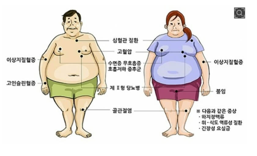 비만에 따른 질환