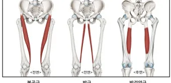 거위발 건염 원인과 증상 무릎 안쪽 통증 치료법 정리_7