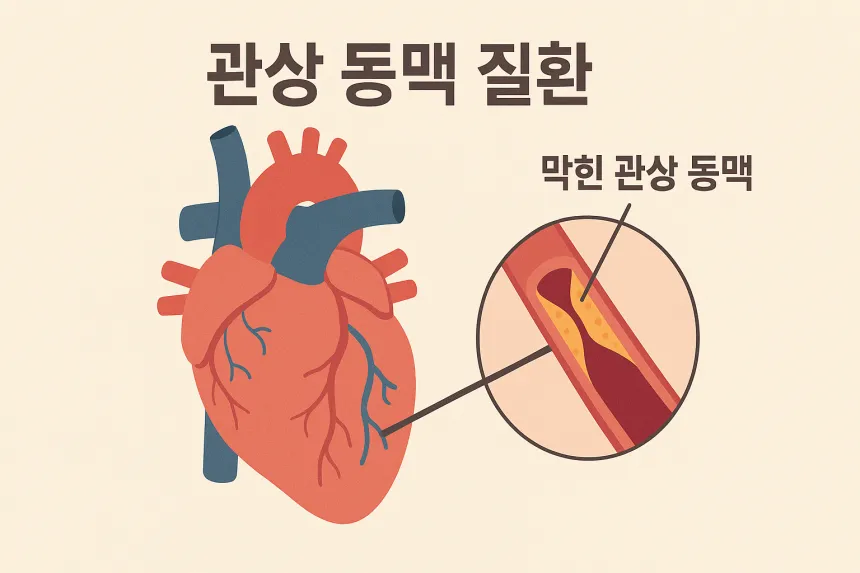급성 심근경색
