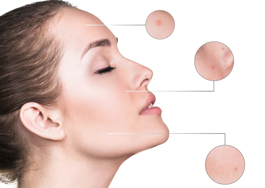 자가면역 질환과 모공각화증의 연관성 알아보기!