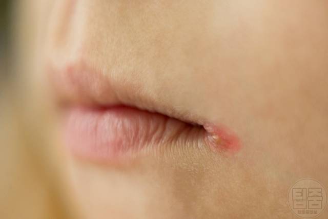 입술 입가찢어짐 구석입술염 세균감염