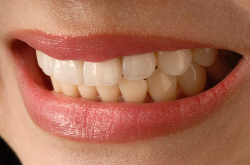 치아임ㅁ플란트-건강보험-적용-치아사진