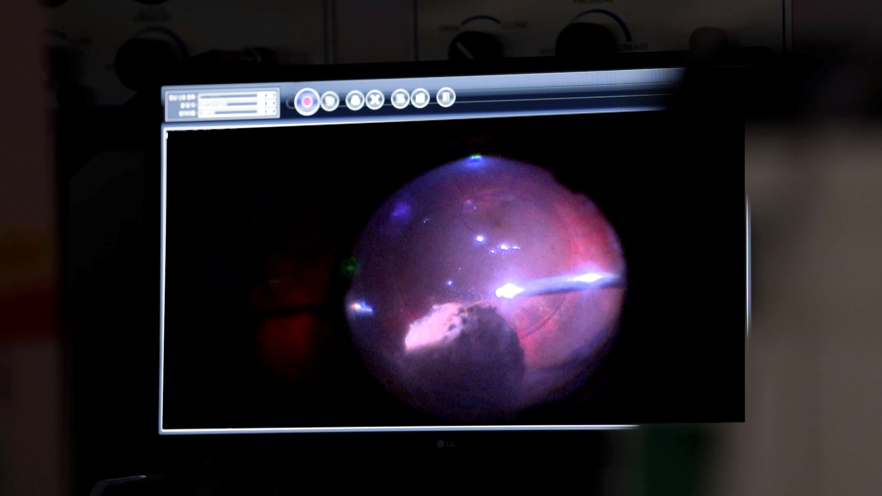 명의 눈속의 점 안구 종양