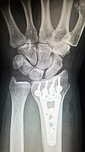 손목터널증후군-이미지