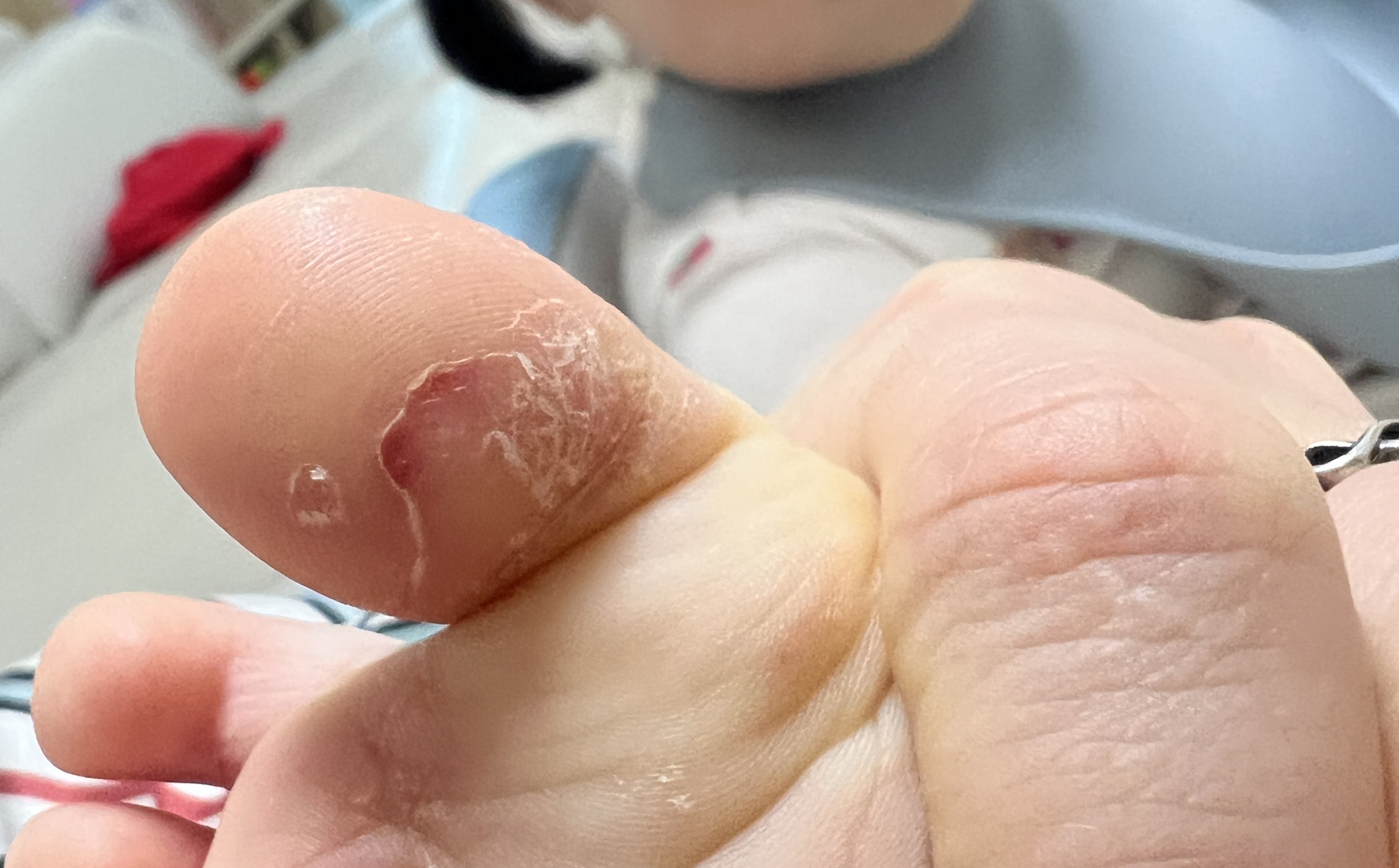 아이 발바닥 발진과 습진