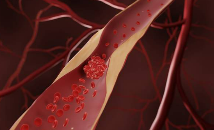 경동맥이 막히는 사진