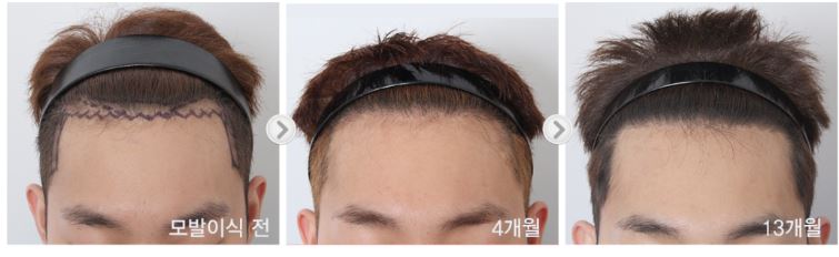 모발이식-병원