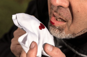 혈담의 원인&middot;병원 진료