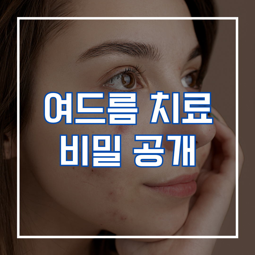 여드름 치료 비밀 공개