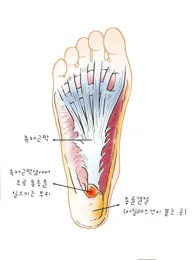 지압슬리퍼 필요성 발 피로 붓기