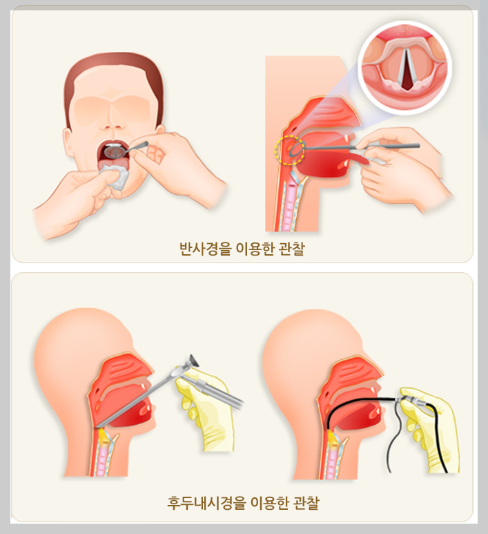 성대결절 검사