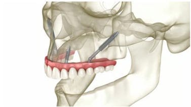 전체 임플란트 장단점